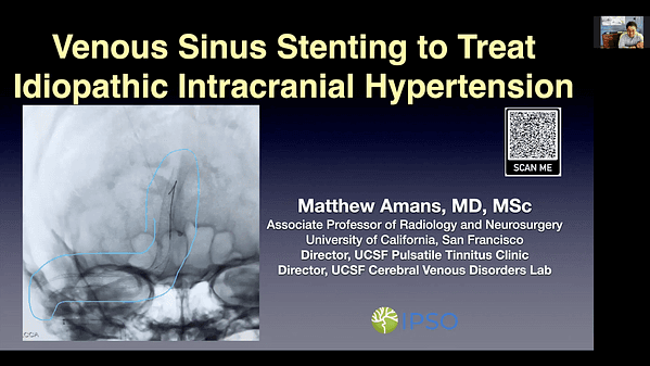 Venous Sinus Stenting to Treat Idiopathic Intracranial Hypertension